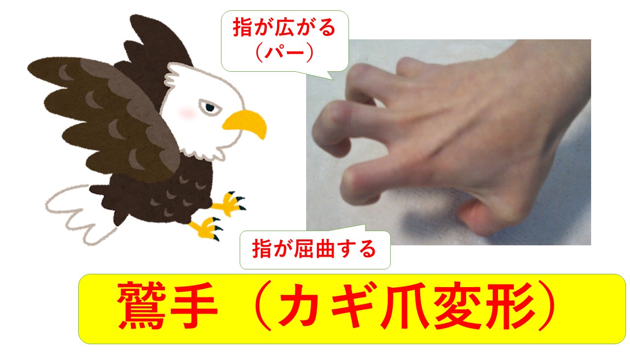 【ねこ太の看護師国家試験勉強】猿手・鷲手・下垂手（正中神経・橈骨神経・尺骨神経）3つの神経麻痺をバッチリ克服！ ねこ太と共に歩む看護未来